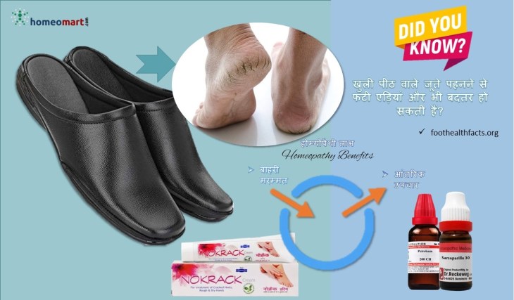 cracked heels treatment in hindi
