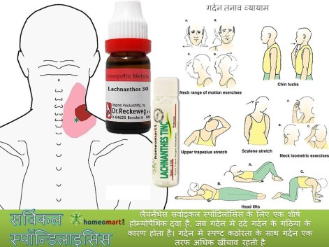 सर्वाइकल का रामबाण उपचार
