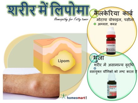लाइपोमा का घरेलू उपचार