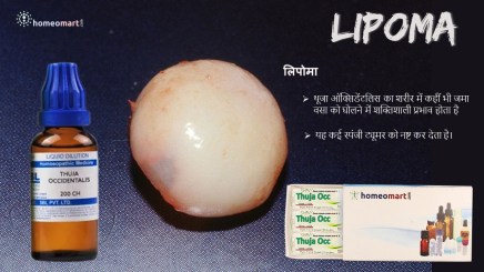 लिपोमा हटाने की दवा थूजा