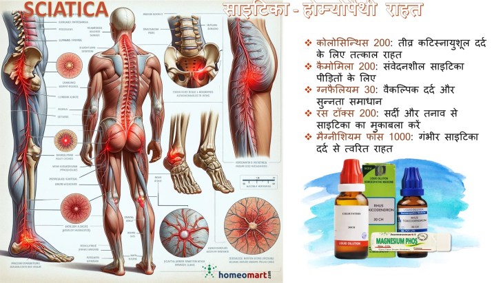 साइटिका का अचूक इलाज