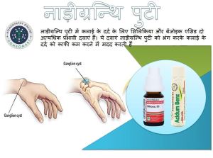" homeopathic remedy for ganglion cyst, नाड़ीग्रन्थि पुटी का होम्योपैथी इलज"