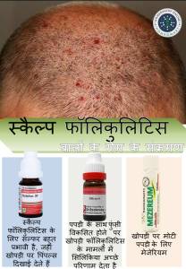 khopdi ya sir me fungal infection ke lakshan, fungus ka desi ilaj in hindi