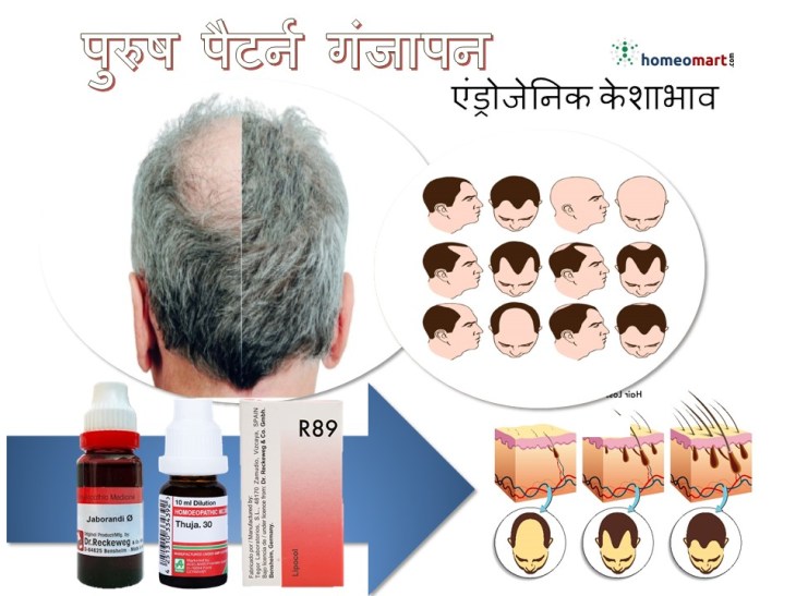 पुरुषों में बाल झड़ने के कारण गंजापन का होमियोपैथी इलाज इन हिंदी