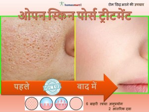 रोम छिद्र मिटाने के उपाय, फेस पैक फॉर ओपन पोर्स, रोम छिद्र भरने का तरीका, ओपन पोर्स के लिए फेस वाश