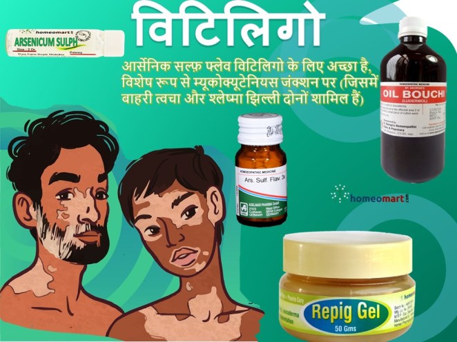 सफेद दाग के घरेलू उपचार Leucoderma in hindi
