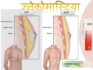 गायनेकोमैस्टिया का घरेलू उपचार पुरुष छाती में गांठ का इलाज