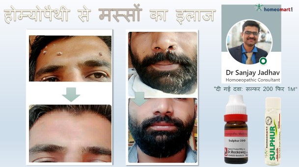 मस्से हटाने की होम्योपैथिक क्रीम, वार्ट्स मीनिंग इन हिंदी, पैपिलोमा का घरेलू इलाज