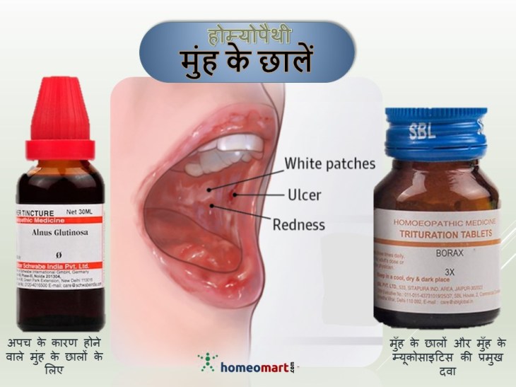 माउथ में छाले की दवा, मुंह में अल्सर का इलाज, मुंह में छाले ठीक करने के लिए घरेलू नुस्खे