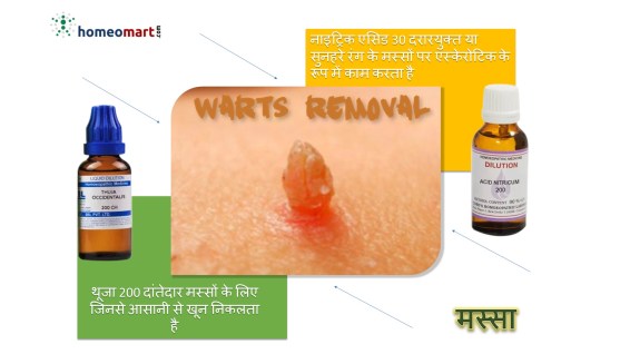 होम्योपैथी में मस्सों को हटाने के लिए नाइट्रिक एसिड