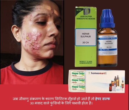 गाल पर पिम्पल होने के कारण