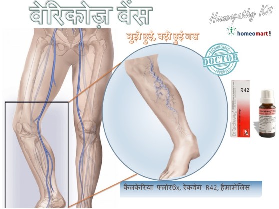 वेरीकोज बीमारी का इलाज, अपस्फीत शिरा के उपचार