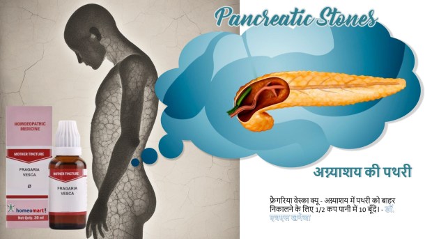  फ्रैगरिया वेस्का क्यू - अग्न्याशय में पथरी को बाहर निकालने के लिए