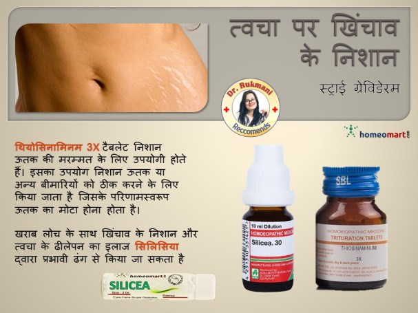 स्ट्रेच मार्क्स होने के कारण, पेट के निशान मिटाने की दवा