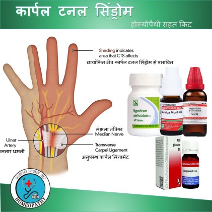 होम्योपैथी में कार्पल टनल सिंड्रोम उपचार