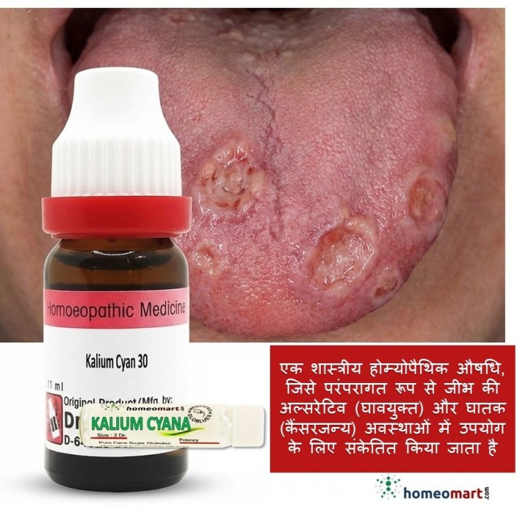 मुंह के छाले (अल्सर)