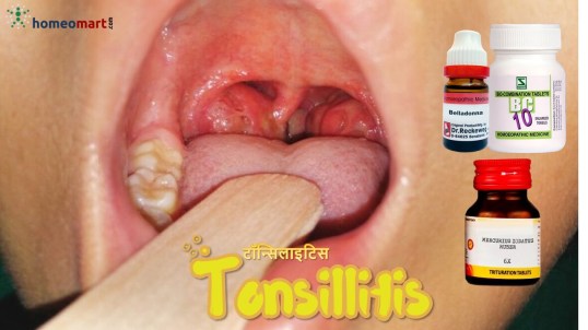 टॉन्सिलिटिस की होम्योपैथी दवा