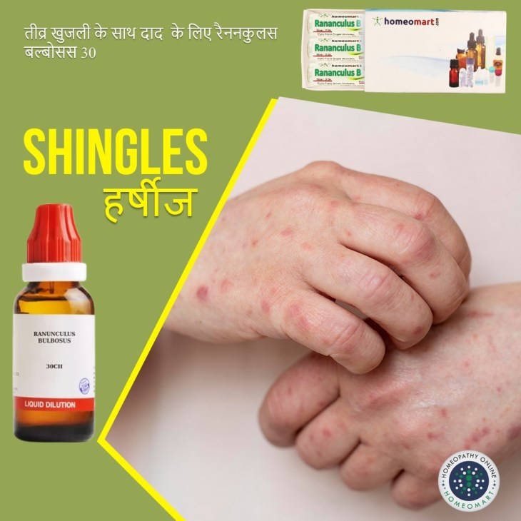 हर्पस ज़ोस्टर उपचार के लिए होम्योपैथी दवाएं