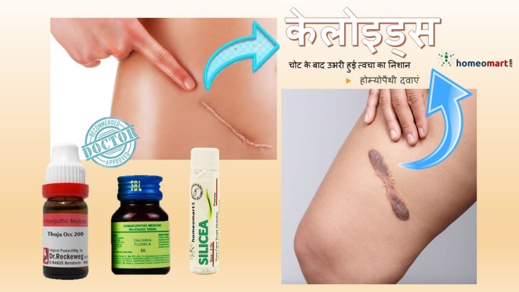 Keloid निकालने का तरीका