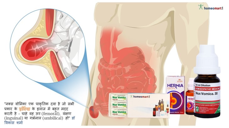 बिना ऑपरेशन हर्निया का इलाज
