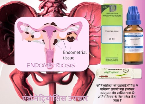 एंडोमेट्रियोसिस - महिलाओं से संबंधित स्वास्थ्य समस्याएं