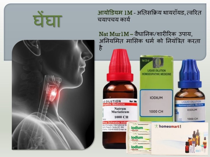  गोइटर (गलगंड) रोग की होम्योपैथी दवा 