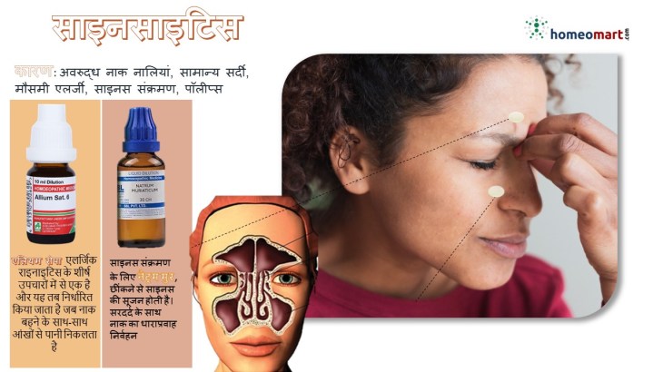 साइनसाइटिस होम्योपैथी दवाएं