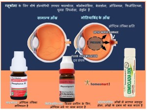 ग्लूकोमा का होम्योपैथी इलाज