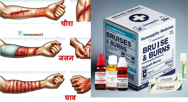 कटना, चोट लगना, जलना, चोटें होम्योपैथी प्राथमिक चिकित्सा उपचार