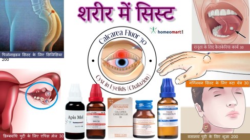 शरीर के पुटी के लिए होम्योपैथी दवाएं