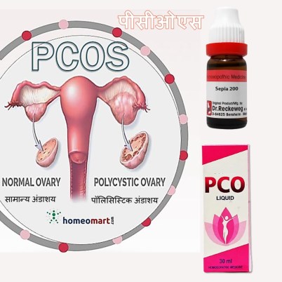 डिम्बग्रंथि पुटी उपचार होम्योपैथी उपचार