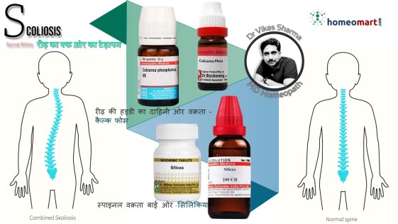 स्पाइनल कर्वेचर रीढ़ की हड्डी के विकार