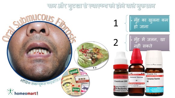 गुटखा पान मसाला खाने के नुकसान