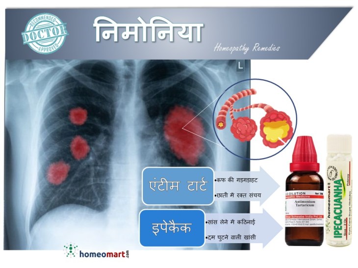 निमोनिया : कारण, लक्षण, जोखिम, निदान और इलाज