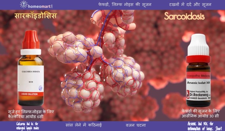 फेफड़ों की सूजन