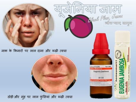 किशोरावस्था में मुँहासे