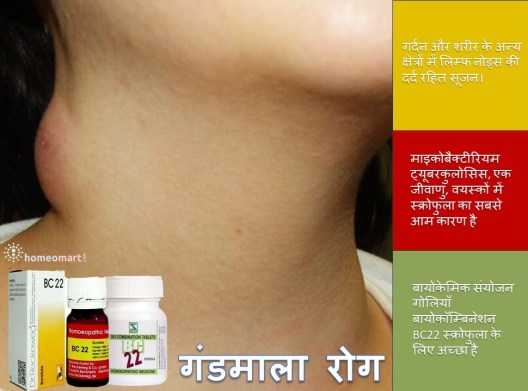 बायोकेमिक संयोजन गोलियाँ बायोकॉम्बिनेशन BC22 स्क्रोफुला के लिए अच्छा है