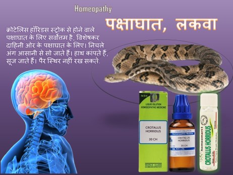 होम्योपैथी में लकवे का इलाज