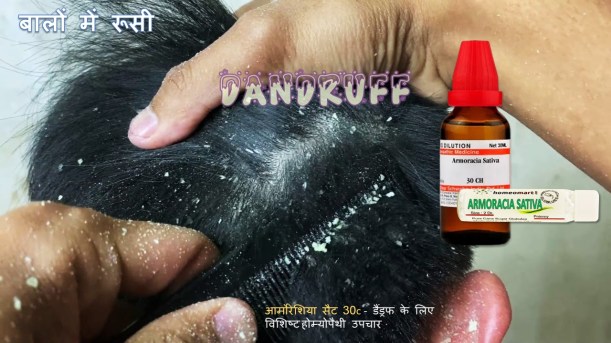 जिद्दी रूसी को दूर करते हैं ये 6 दमदार नुस्खे