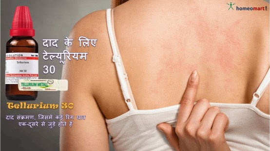  दाद का परमानेंट इलाज 