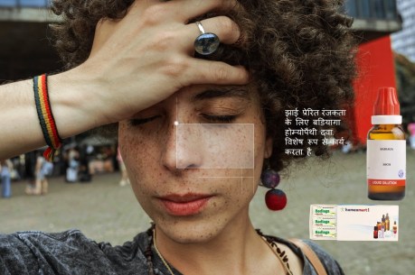 झाइयों से प्रभावित त्वचा रंजकता का उपचार