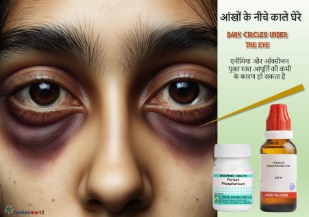 आंखों के नीचे के गहरे काले धब्बे