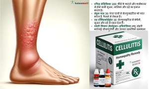 सेलुलाइटिस के लक्षण, कारण, इलाज, दवा,