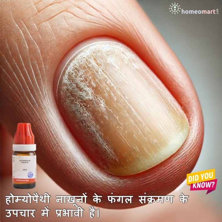 नाखून फंगस के लिए प्रभावी होम्योपैथिक उपचार 