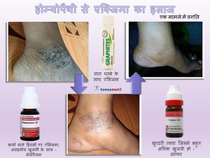 eczema relief with homeopathy in hindi